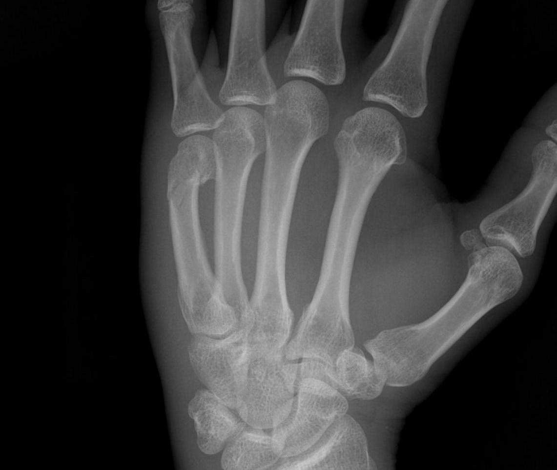 Neck of Fifth Metacarpal Fracture